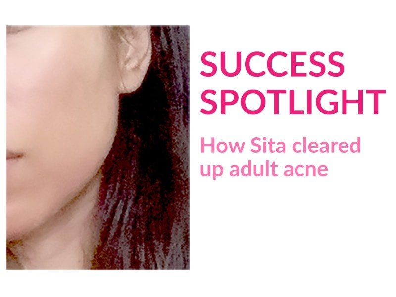 Sita tells her story how she cleared up stubborn adult acne