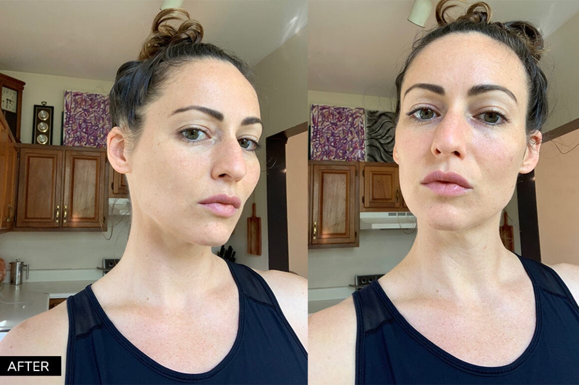 Saree Silverman testimonial and before and after photos from acne coaching with Natasha St. Michael